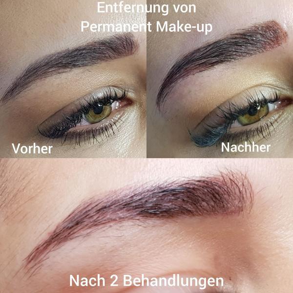 Pigmententfernung ohne Laser