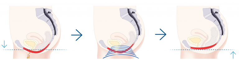 Beckenbodenmuskulatur